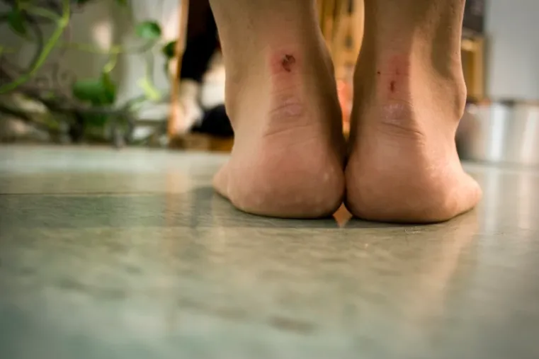 How to play football with blisters and tips to avoid them